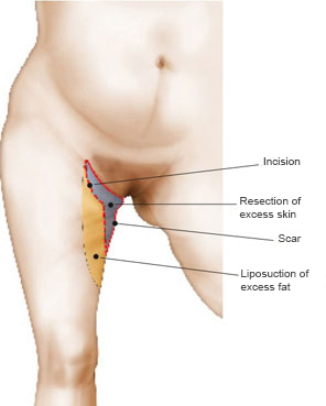 Thigh-lift-technique-combined-in-T